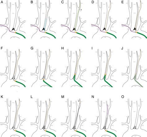 The Modified No Touch Technique In The Antegrade Endovascular