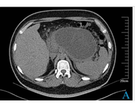 Walled Off Pancreatic Necrosis