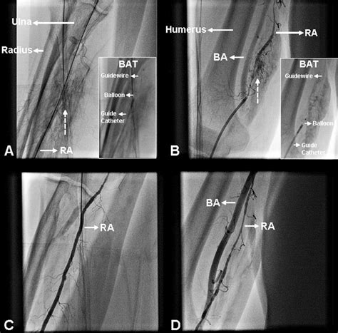 Radial Artery RA Angiograms A Perforation Of The RA With