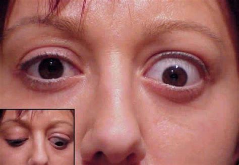 retraccion palpebral  es  causas area oftalmologica avanzada