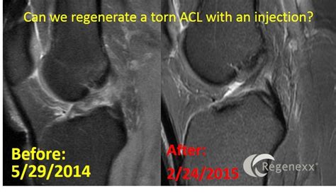 Acl Surgery Complications Acl Surgery Surgery Meniscus Tear