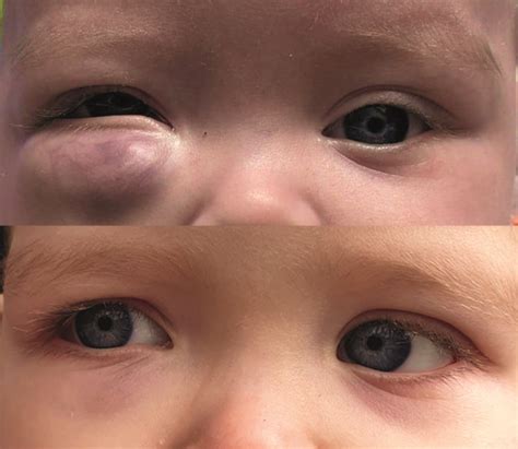 Eyelid Hemangioma