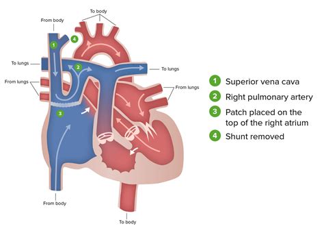 Tricuspid Valve Atresia (TVA) | Concise Medical Knowledge