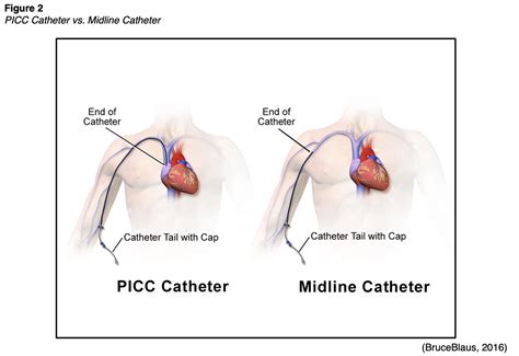 Vascular Access Devices Part 1 Nursing CE Course NursingCE