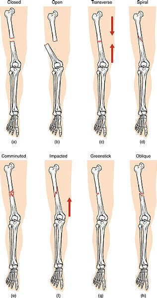 Broken Bones Signs Symptoms And Causes