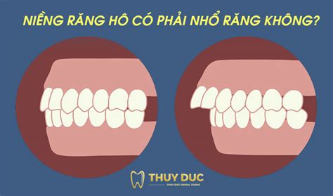 Quá Trình Niềng Răng Hô Nhổ Răng Những Điều Cần Biết Trước Khi Thực Hiện