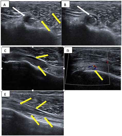 A Retrospective Case Series Of Patient Reported Response To Ultrasound Guided Corticosteroid