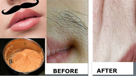 DIY Remove Unwanted Hairs Naturally At Home 100 Result Permanent