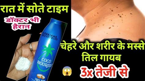 तिल और मस्से को जड़ से ख़त्म करने का सबसे अच्छा उपाय Remove Skin Tag