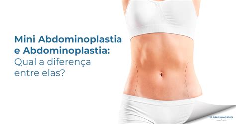 Miniabdominoplastia E Abdominoplastia Qual A Diferen A Entre Elas