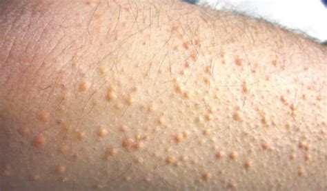 Eruptive Xanthoma Causes Symptoms Diagnosis And Treatment