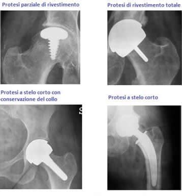 Protesi D Anca Quali Sono I Rischi E I Tempi Di Recupero