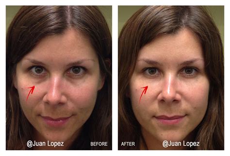 tear trough enhancement dermal filler skinmedico clinic london