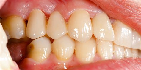 Gum Line Cavity Symptoms Cure And Treatment Methods Zwivel