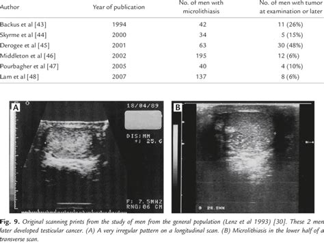 Microlithiasis And Testis Cancer Prevalence Or Development Download Table