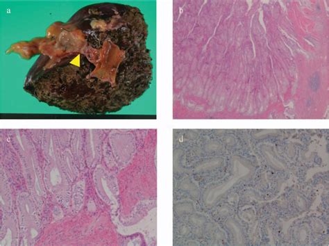 Figure 2 From Primary Papillary Hyperplasia Of The Gallbladder