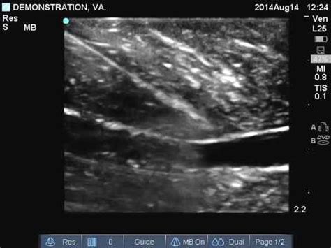 Ultrasound Guided Vascular Access In Plane Longitudinal View YouTube