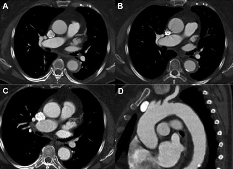 Contrast Enhanced Computed Tomography Angiography Cta Of An