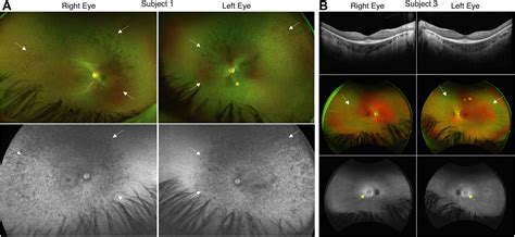 Genetic Reasons For Phenotypic Diversity In Neuronal Ceroid