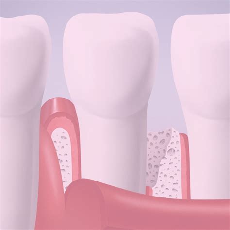 Injerto De Enc A Centro Periodontal De Valencia