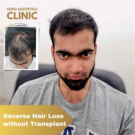 Hair Loss Treatment PRP Hair Growth Programme