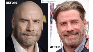 John Travolta's Hair Transplantation - MCT