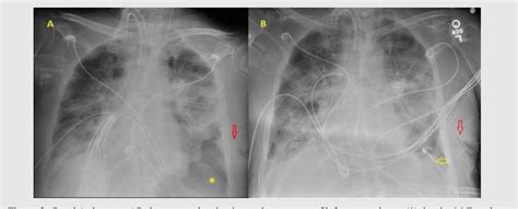 Figure 1 from Loculated pneumothorax with a deep sulcus sign | Semantic ...