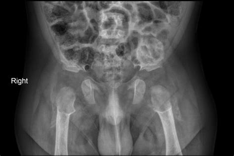 Achondroplasia X Ray Vs Normal