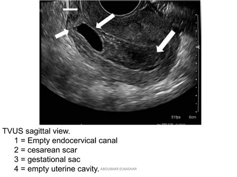 Cesarean Scar Ectopic Pregnancy Current Management Strategies Ppt