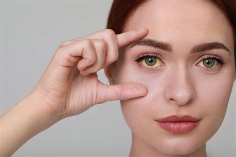 Woman With Yellow Eyes On Light Grey Background Symptom Of Hepatitis