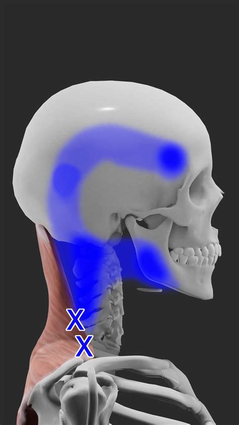 Acupuncture For Trapezius Trigger Points — Morningside Acupuncture Nyc