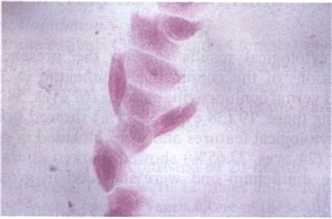 Impression Cytology From A Vernal Conjunctivitis Patient Showing A Download Scientific Diagram