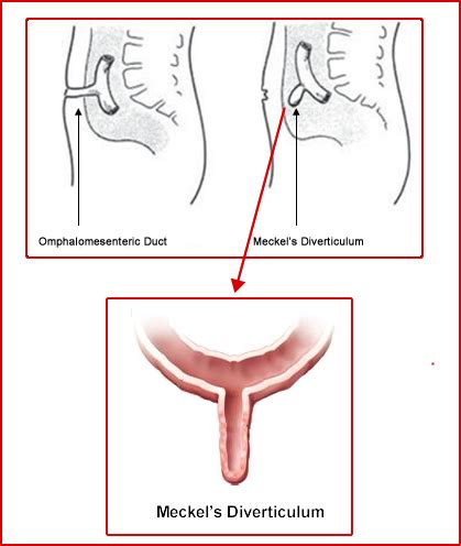 Meckels Diverticulums