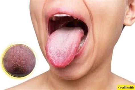 How To Get Rid Of Bumps On The Back Of The Tongue Credihealth