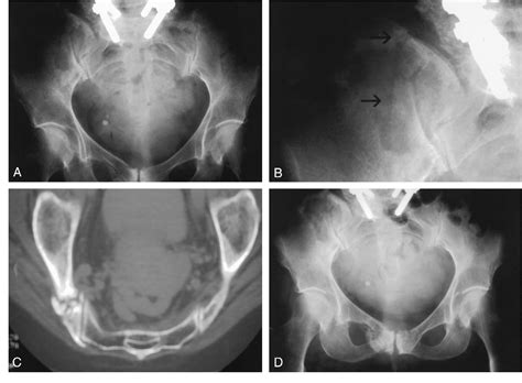 Figure 1 From Early Fracture Of The Sacrum Or Pelvis An Unusual Complication After Multilevel