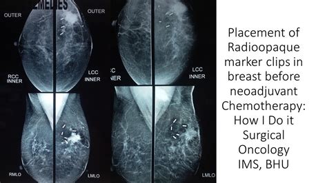 Placement Of Marker Clips In Breast Before Neoadjuvant Chemotherapy