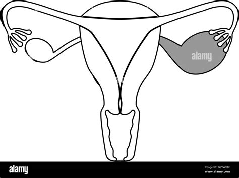 Diagrammatic Illustration Of Endometriosis Anatomy Of The Uterus And