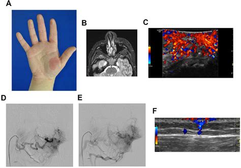 Figure 1 From Somatic Second Hit Mutation Of Rasa1 In Vascular Endothelial Cells In Capillary