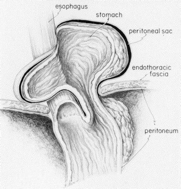 Laparoscopic Management Of Giant Paraesophageal Herniation The Annals