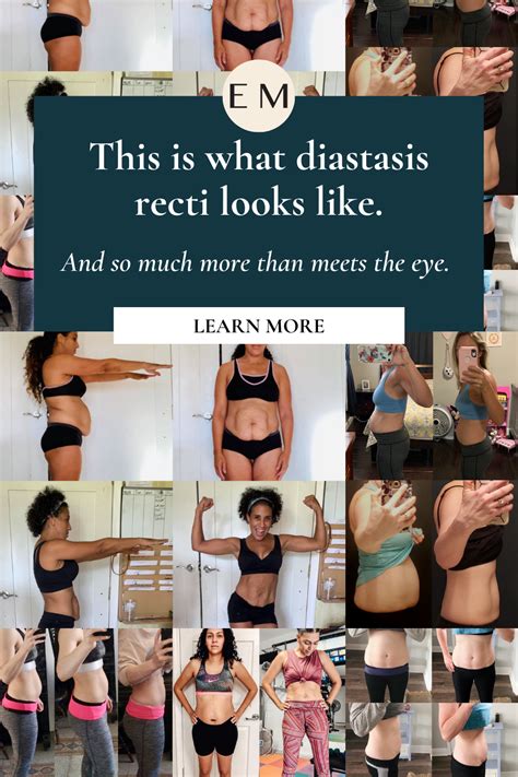 What Is Diastasis Recti Artofit