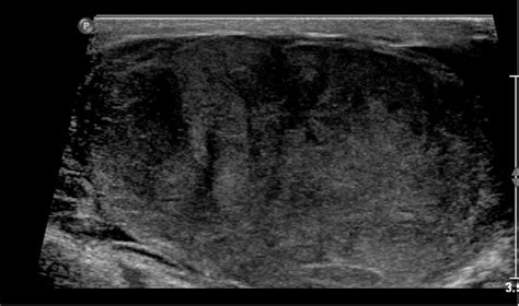 Figure 1 From Intra Scrotal Testicular Torsion Of A Classical Seminoma