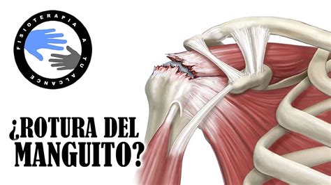 Dolor De Hombro Test Para Saber Si Tu Manguito Rotador Tiene Una