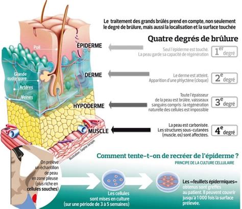 Une Bio Imprimante Portable Permet De Traiter Les Br Lures S V Res En Y