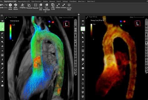 Fda Approves Innovative D Flow Mri Blood Flow Analysis Software From