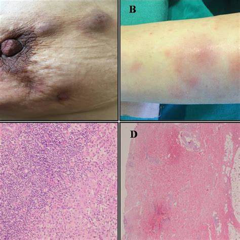 Microscopic Image In Plasma Cell Mastitis Inflammatory Infiltrate With