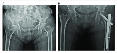 (A) Preoperative X-ray of the left hip intertrochanteric fracture ...