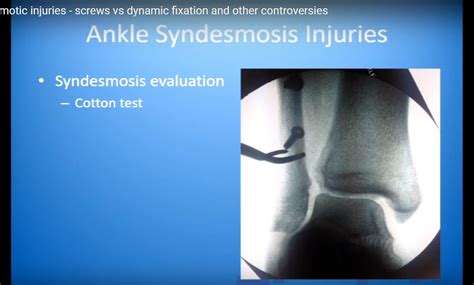 Ankle Syndesmotic Injuries —