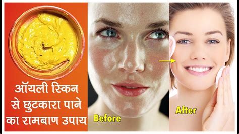 Face Pack To Cure Oily Skin Oily Skin Ke Liye Problem Of Pimples