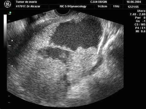 Malignant Ovarian Tumors Serousmucinousendometrioidclear Cell