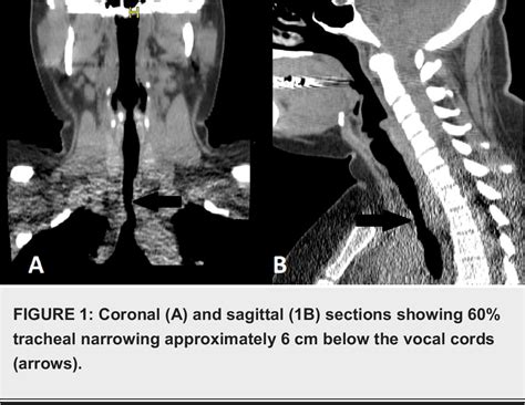 Figure 1 From Idiopathic Subglottic Tracheal Stenosis Misdiagnosed As